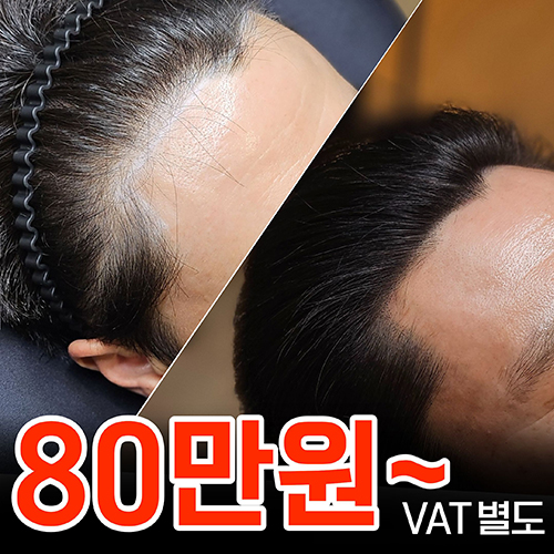 헤어라인 사례