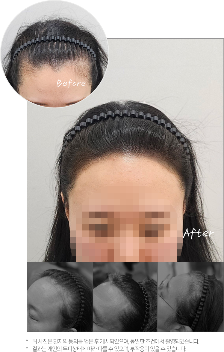 대구 헤어라인 두피문신 전후사진